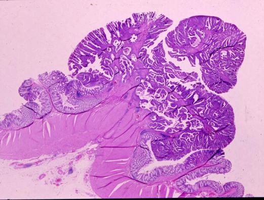 大腸腺腫組織像（倍率はフィルムで２倍程度）